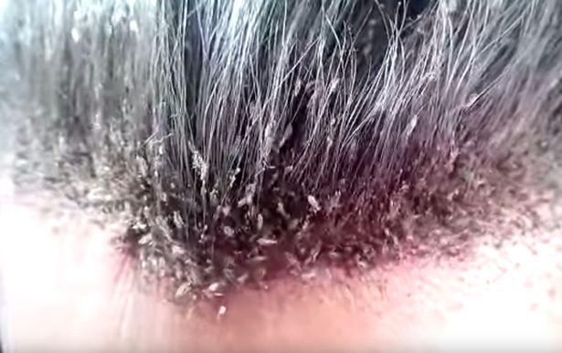head-lice